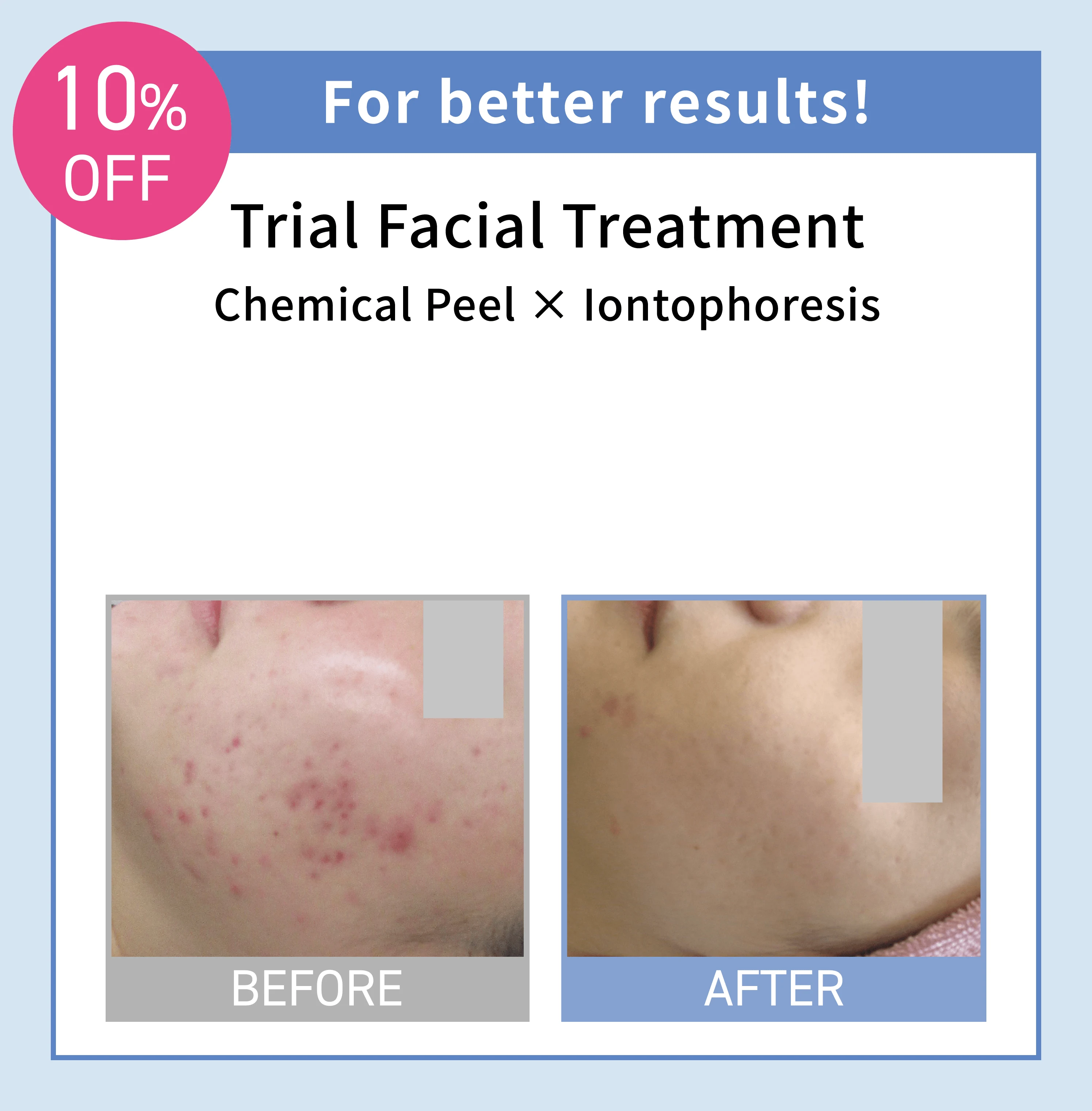 For better results! Trial Facial Treatment Chemical Peel × Iontophoresis 10% OFF