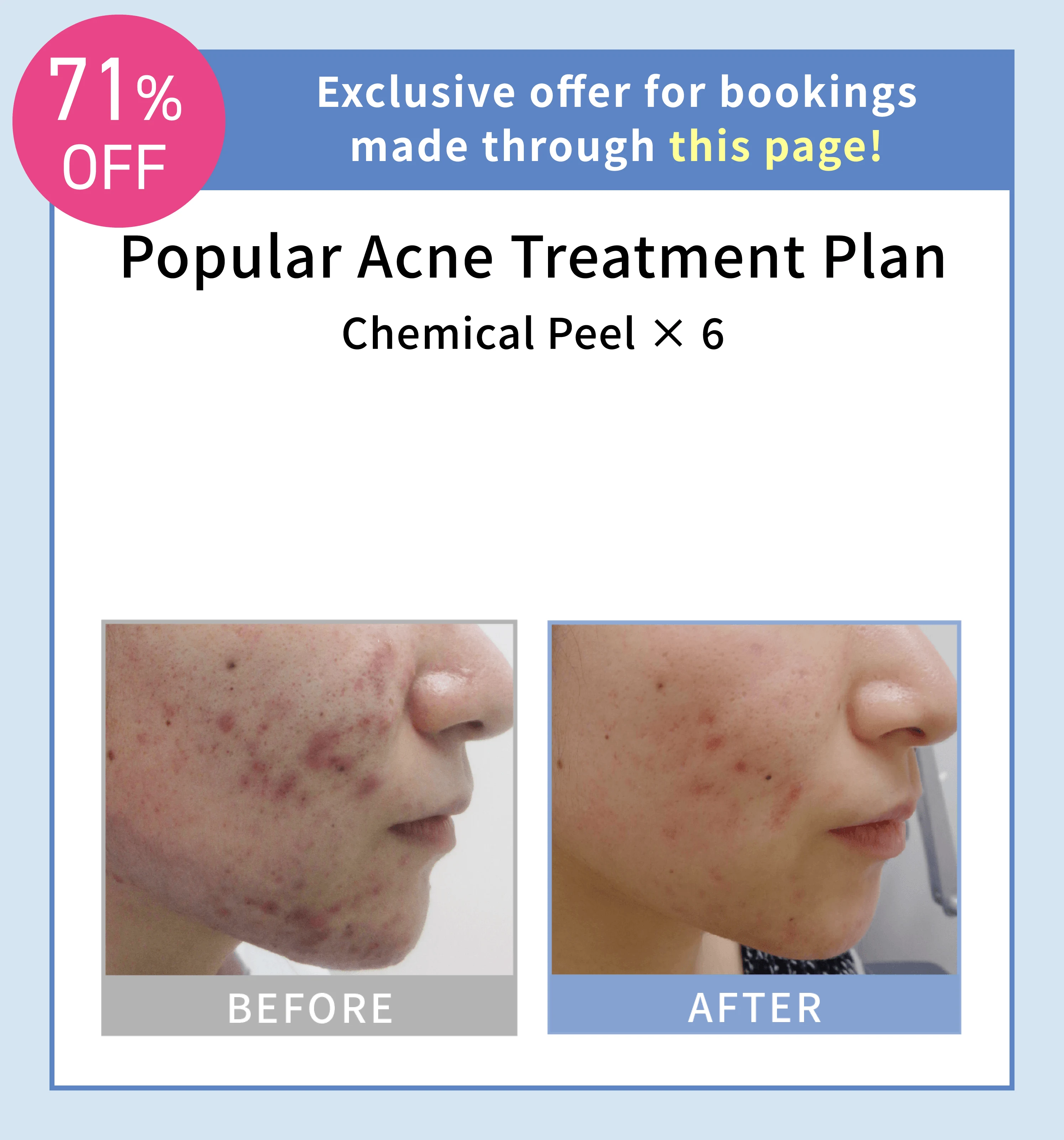 Exclusive offer for bookings made through this page! Popular Acne Treatment Plan Chemical Peel × 6 71% OFF