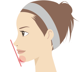 Illustrated effect of hyaluronic acid injection